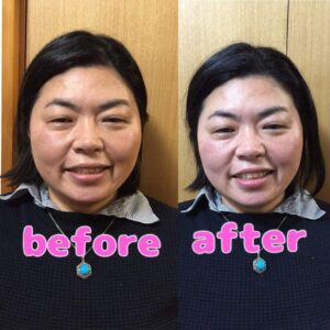 小顔マジック前と後の写真